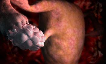 Фото:Дисфункции яичников что это такое?